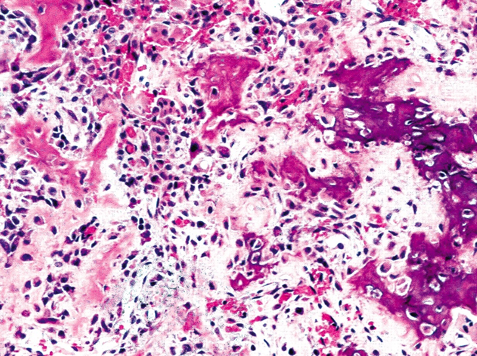 Pathology Outlines - Osteoblastoma